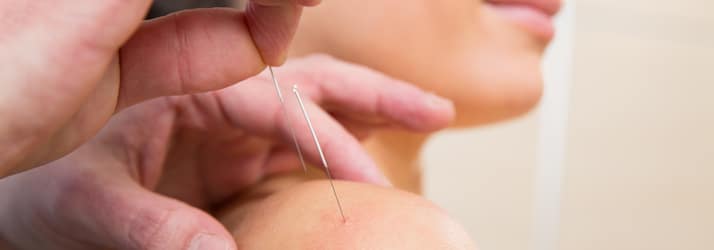 Acupuncture in Elmhurst IL Acupuncture in Elmhurst IL